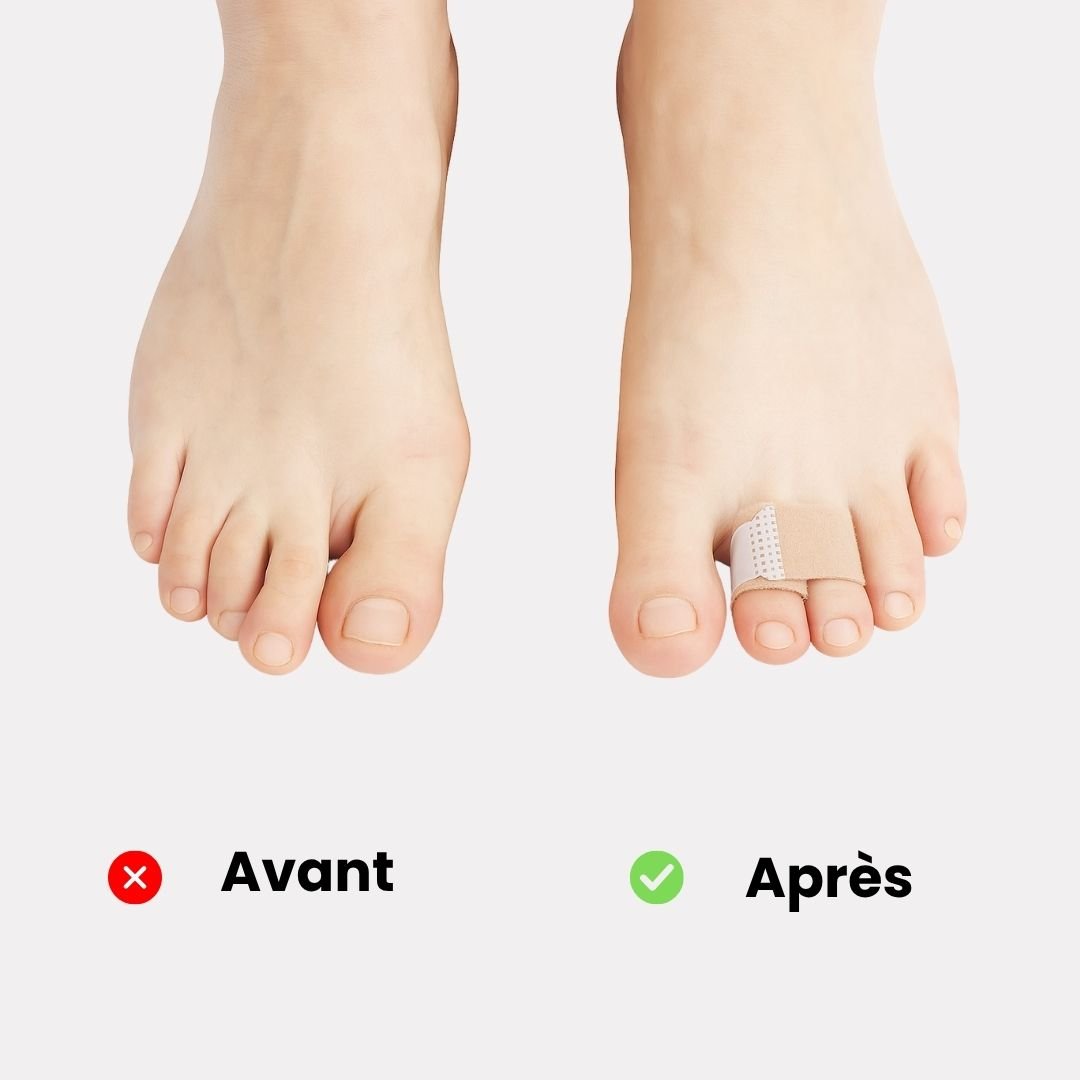 Strap Correcteur Orteil en Griffe – Orthèse Réglable pour Soulager la Douleur et Redresser les Orteils Déformés